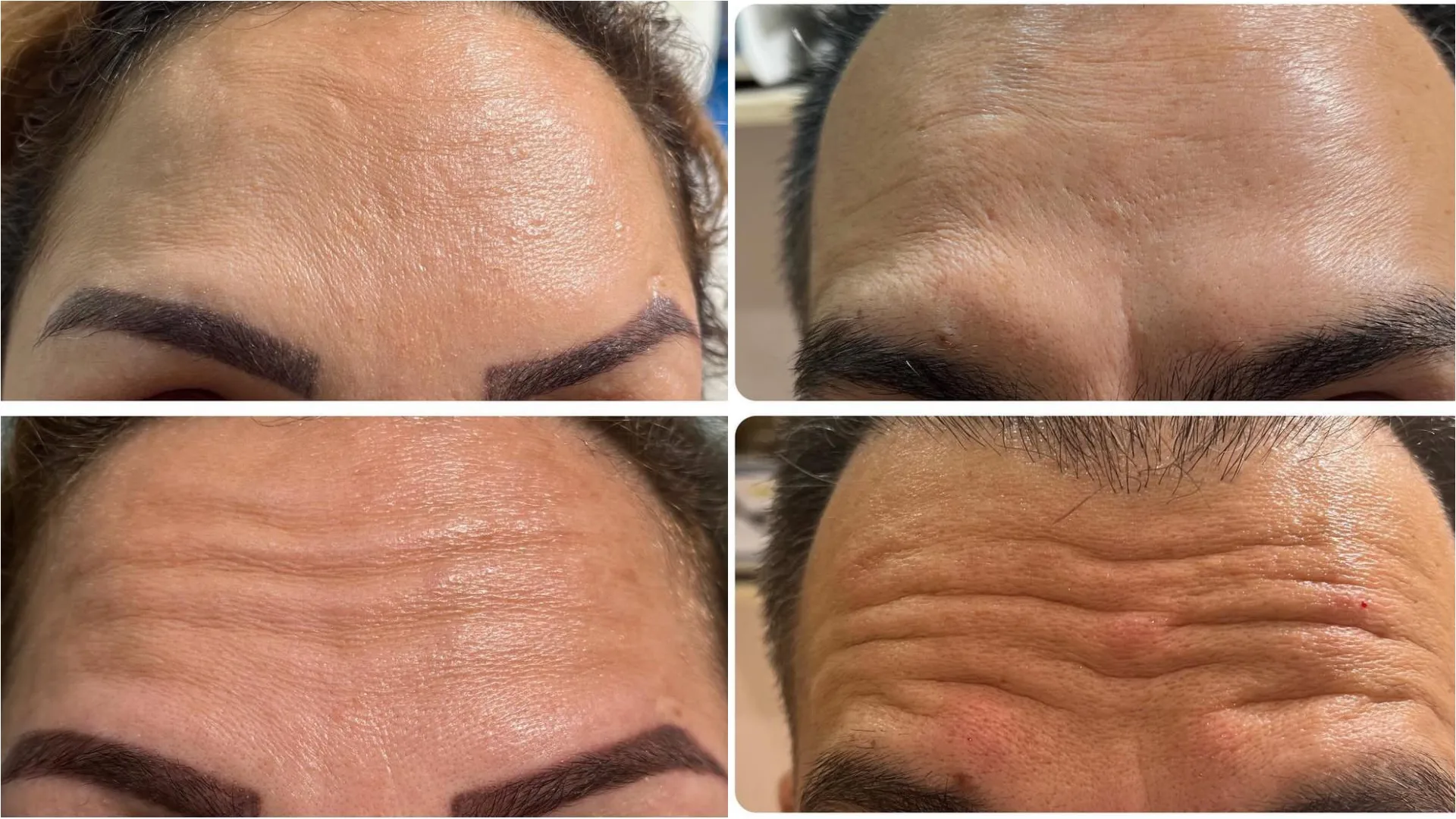 Before and after forehead wrinkle treatment results, showing smoother skin.
