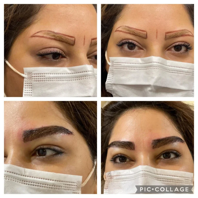 Before and after eyebrow transplant, showing new hair growth and fuller brows.