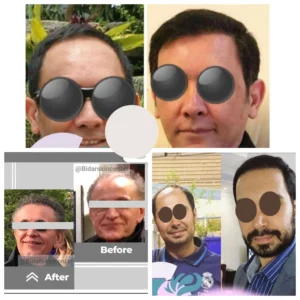 Before and after photos showcasing successful hair transplant results on three different men, demonstrating improved hair density and hairline.