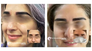 Before and after close-up photos of a woman's face, showcasing significant improvement in eyebrow density and shape following an eyebrow transplant.