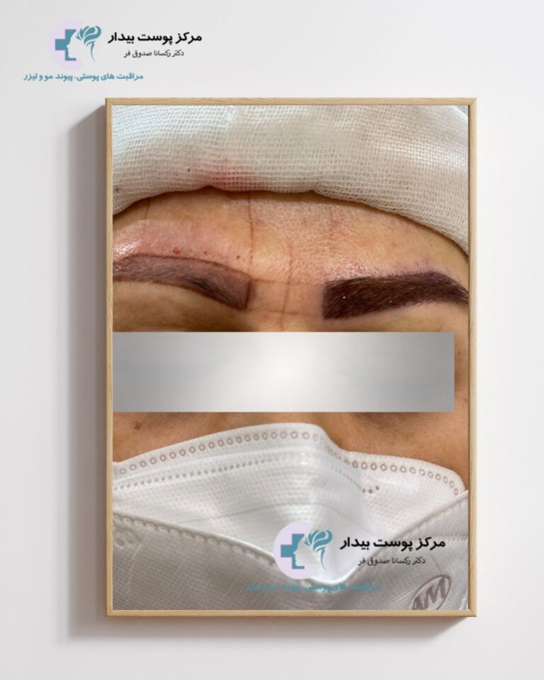 Eyebrow Transplant Without Surgery in Tehran ( photo result )