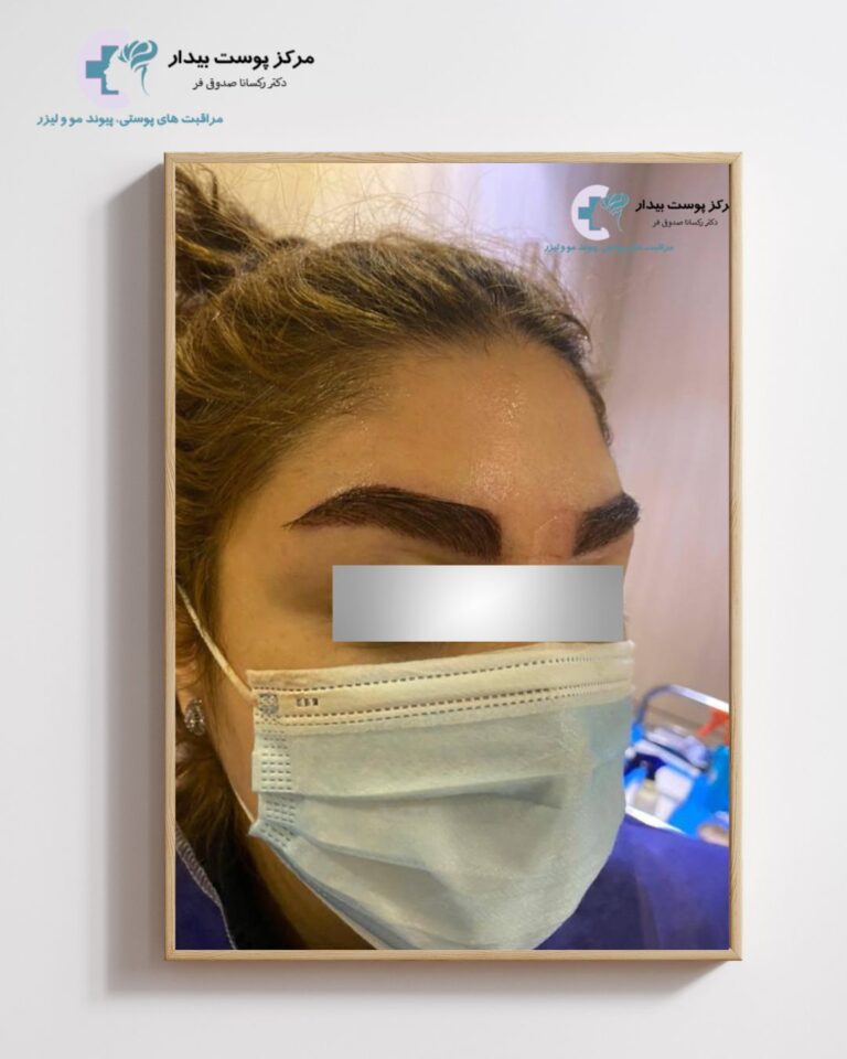 Eyebrow transplant without surgery tehran