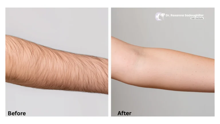 Laser hair removal tehran