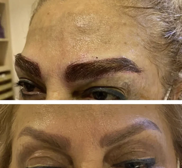 eyebrow transplant without surgery in tehran