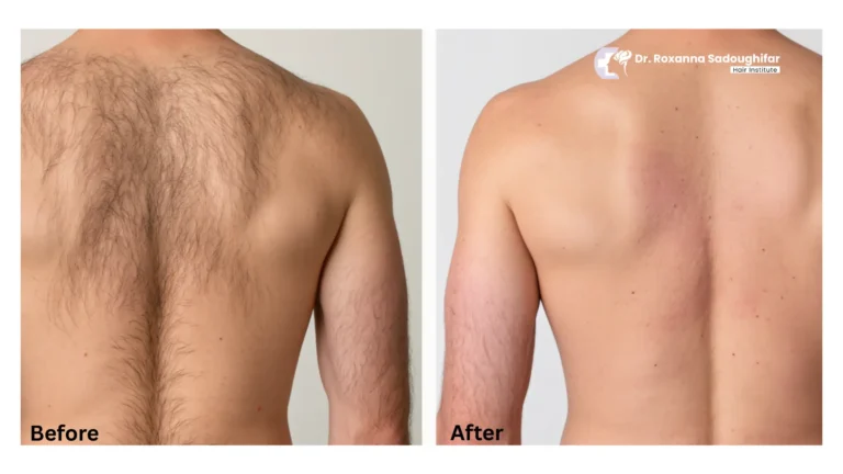 laser hair removal clinic tehran