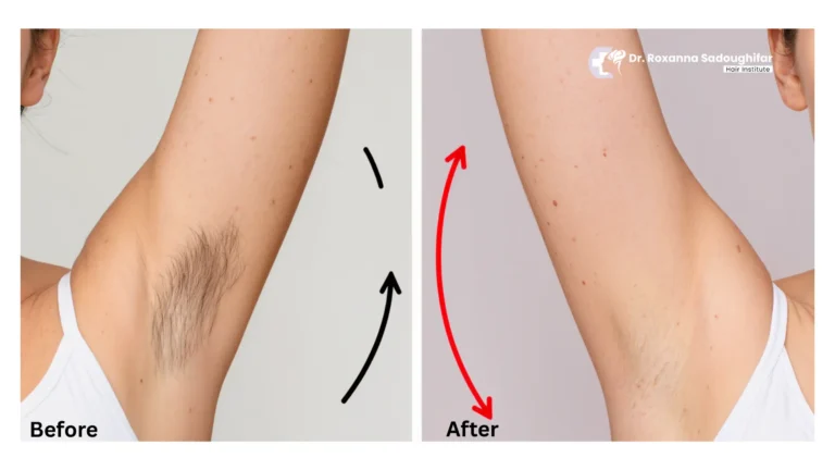 laser hair removal in tehran iran