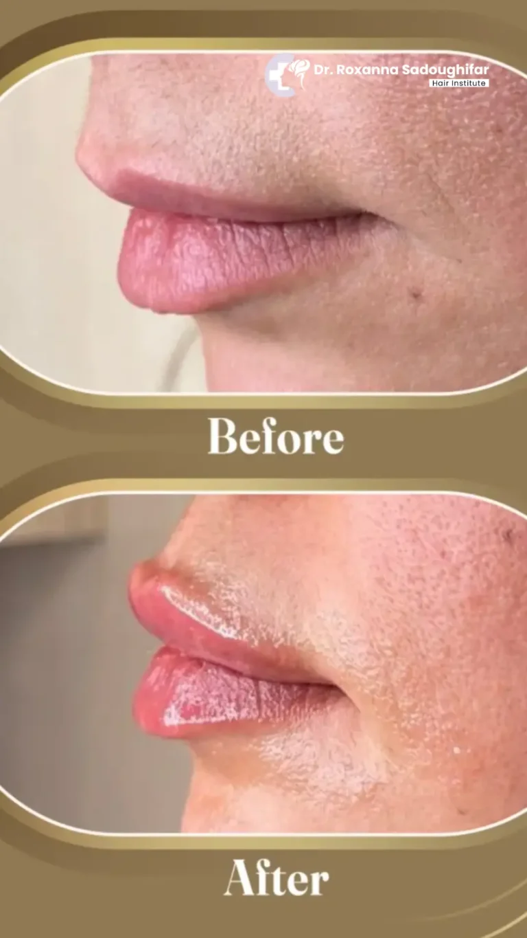 lip augmentation in tehran