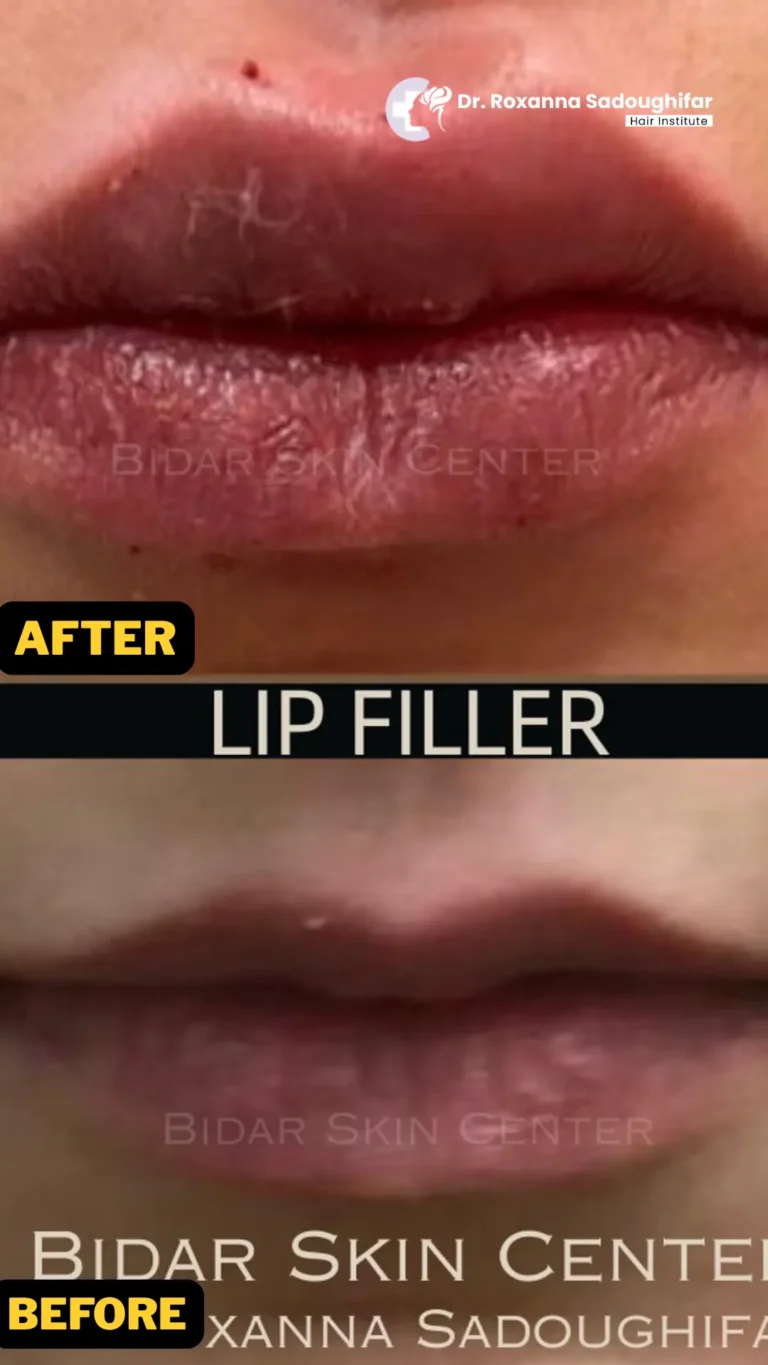 lip filler tehran photos