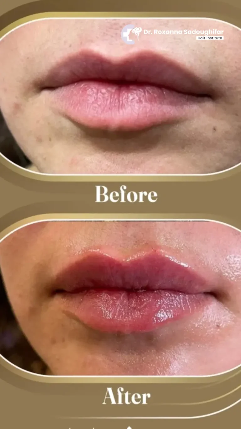 lip fillers in tehran
