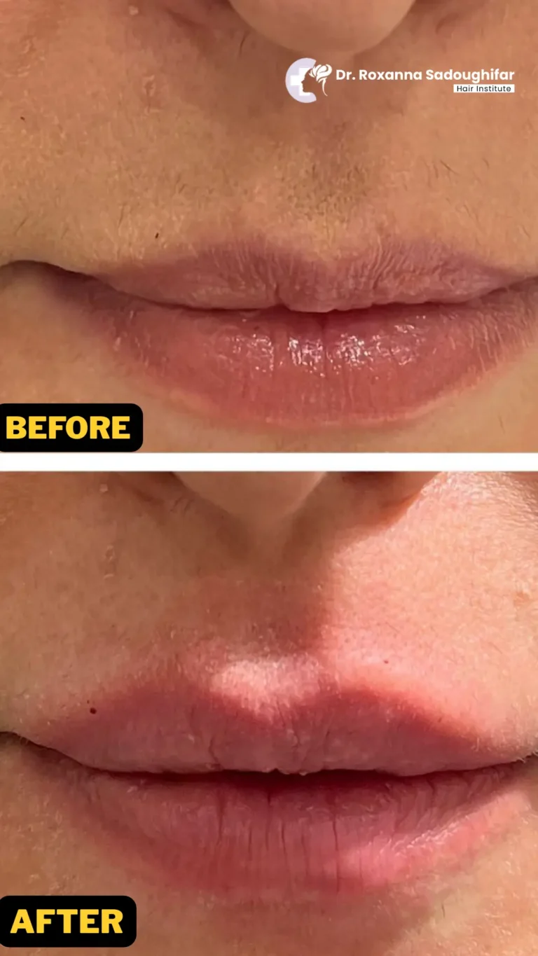 lips fillers in Tehran results photo