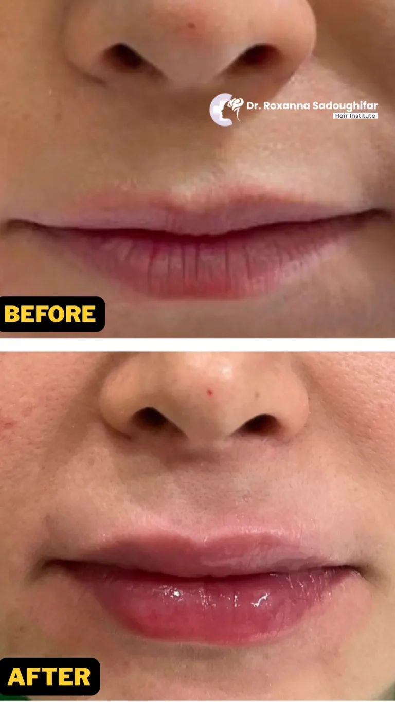 lips fillers tehran before after photos