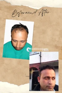 Before and after hair transplant photo