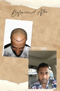 Hair Transplant Before and After Result Iran