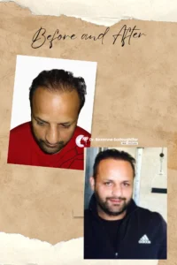 Hair Transplant Result Iran