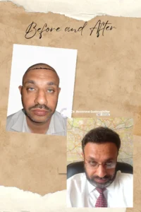 Hair Transplant Result Tehran