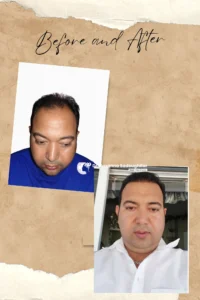 Hair Transplant Review iran