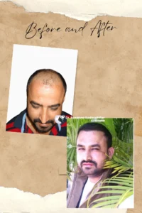 Hair Transplant clinic in Tehran