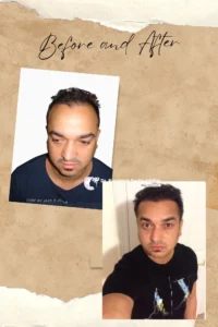 Hair Transplant cost 2026