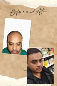 Hair Transplant cost iran