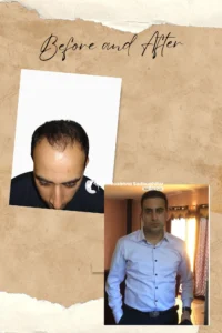 Hair Transplant result review photo