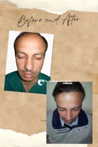 Hair transplant results with cost