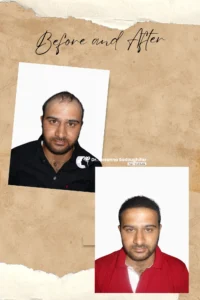 best hair transplant photo iran
