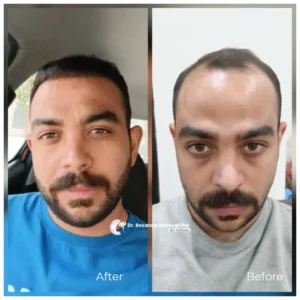 Before and after hair transplant result showing a man with significant frontal hair loss in the before image and a restored, natural-looking hairline with improved hair density in the after image.