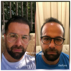 Before and after hair transplant comparison showing a man with a receding hairline and frontal hair loss in the before image and a restored hairline with improved density in the after image.