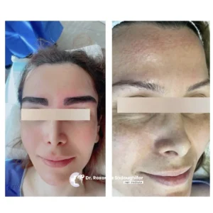 Before and after eyebrow restoration treatment showing a female patient. The left image displays fuller, darker, and well-defined eyebrows with improved facial appearance, while the right image shows sparse eyebrows and reduced density before treatment. The patient's eyes are covered for privacy.