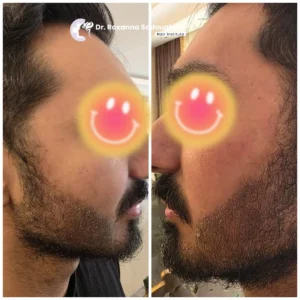 Before and after beard transplant result showing improved beard density, sharper beard line, and natural facial hair growth performed at Dr. Roxanna Sadoughifar Hair Institute.