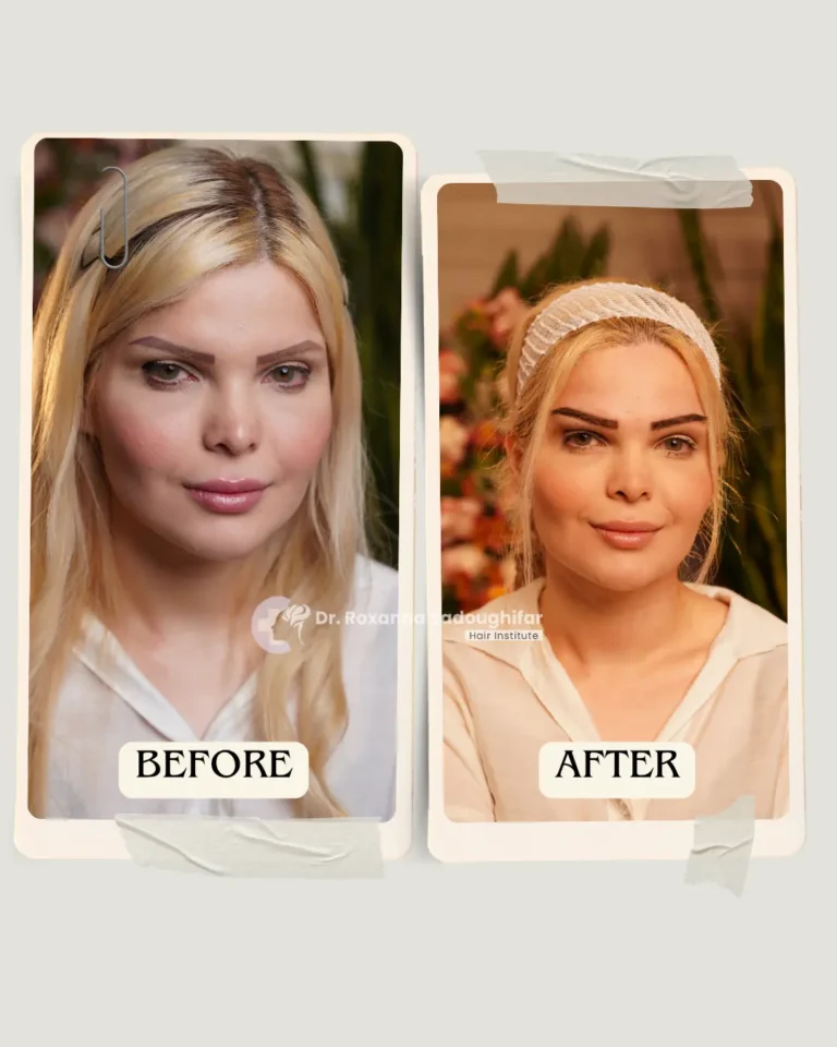 Before and after eyebrow transplant results showing improved eyebrow density and shape, presented by Dr. Roxanna Sadoughifar Hair Institute in Tehran, Iran. The image highlights an eyebrow restoration result associated with eyebrow transplant without shaving.