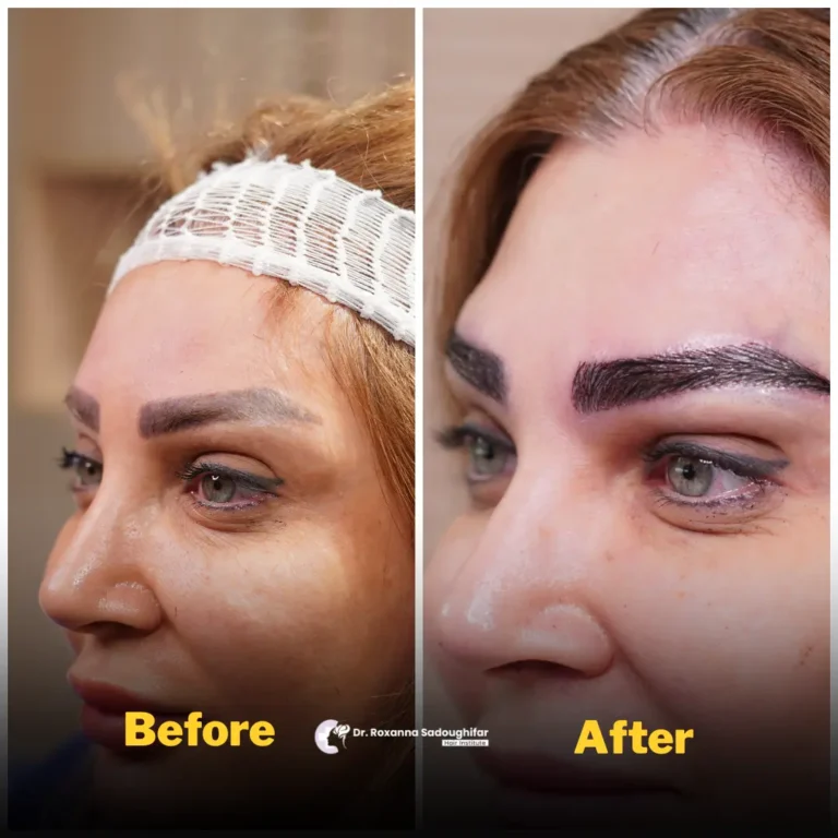 Before and after eyebrow transplant in Tehran, Iran, showing fuller, denser, and naturally shaped eyebrows.