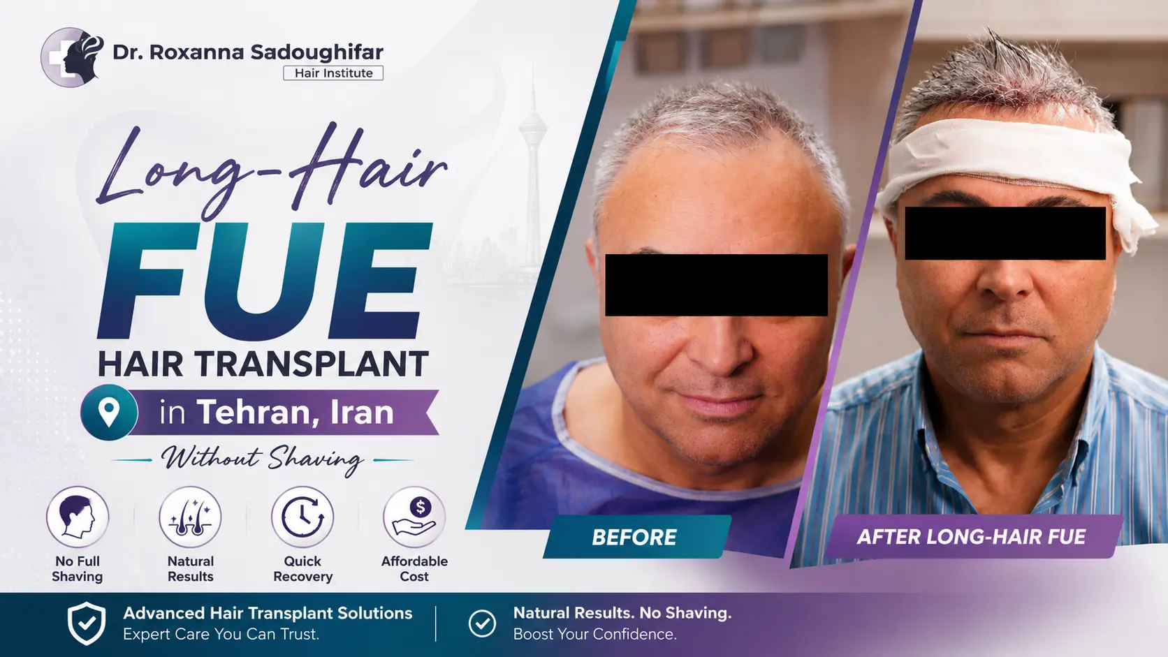 Long-Hair FUE hair transplant in Tehran, Iran infographic featuring before-and-after patient photos and highlighting no shaving, natural results, quick recovery, and affordable cost.