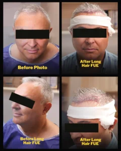 Long Hair FUE in Tehran, Iran – before and after hair transplant results without shaving.