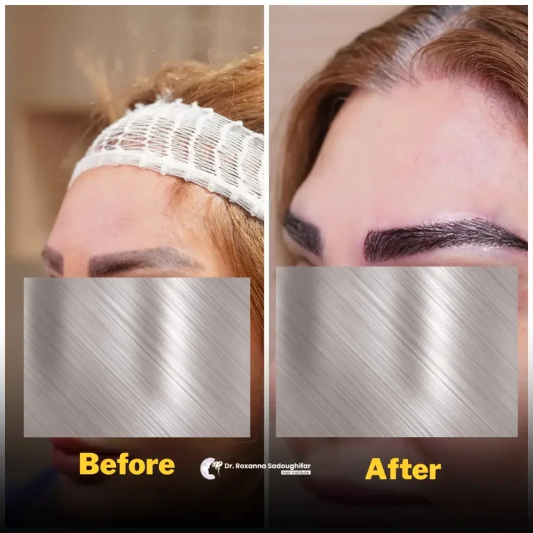 Before-and-after comparison showing a woman’s eyebrow appearance, with a fuller and more defined eyebrow shape in the after image.