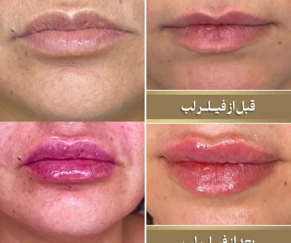 Before and after lip filler treatment, showing fuller, more defined lips.